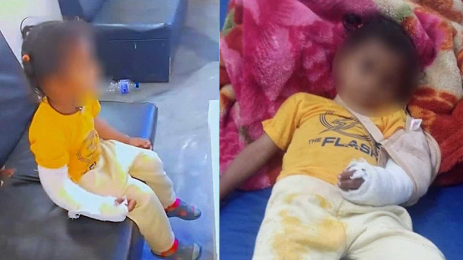 देब्रे हात भाँच्चिएका बालकको दाहिने हातमा प्लास्टर, डाक्टरको लापर्वाहीले ७ वर्षीय बालक भाईरल