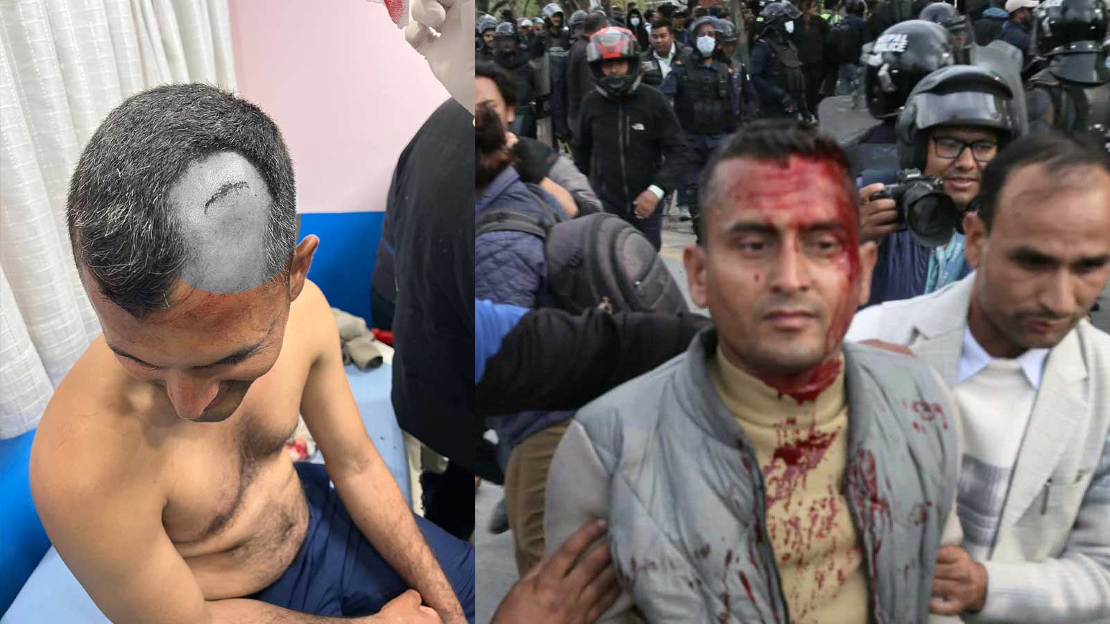 ओली पक्राउविरुद्ध देशभर उग्र प्रदर्शन, काठमाडौँमा प्रहरी–एमाले कार्यकर्ता झडप